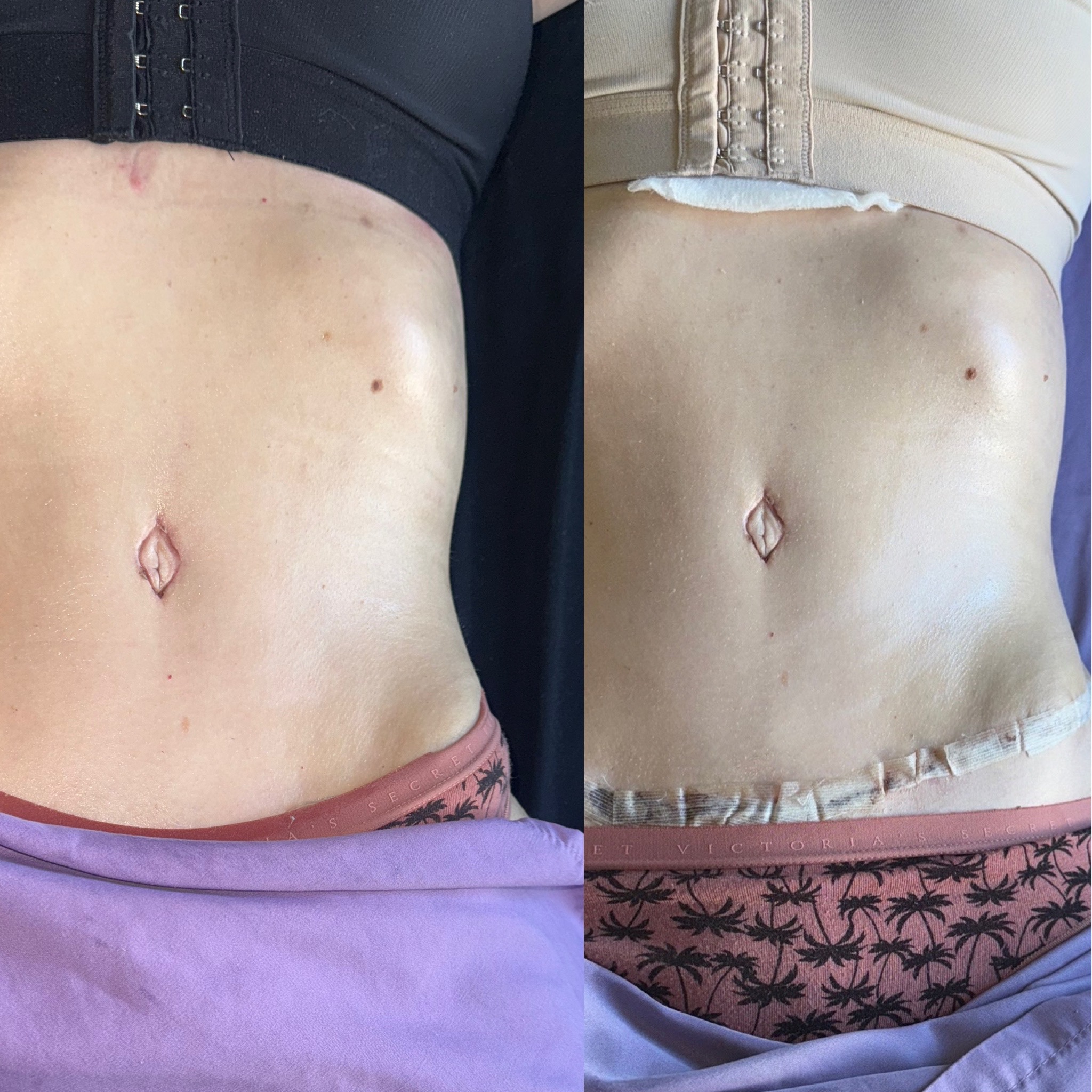 Lymphatic drainage before and after result