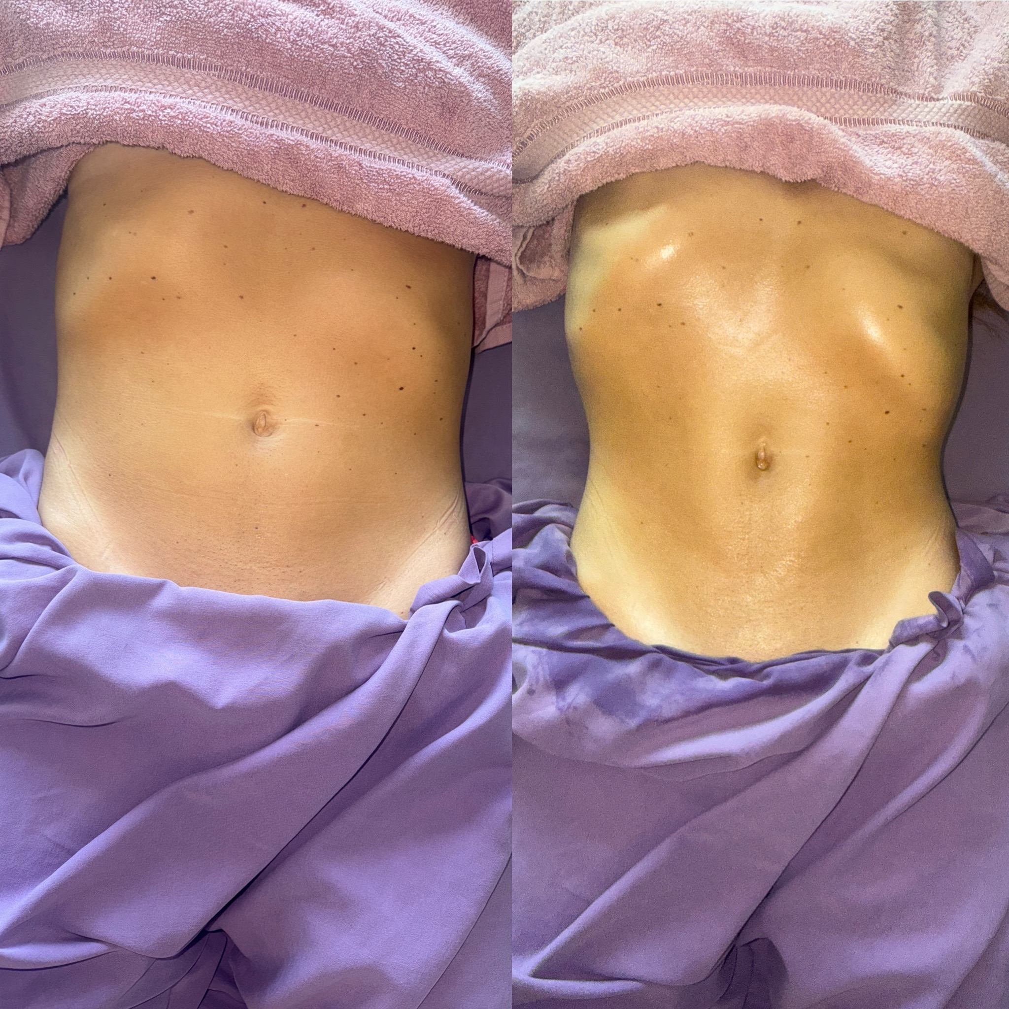 Lymphatic drainage before and after result