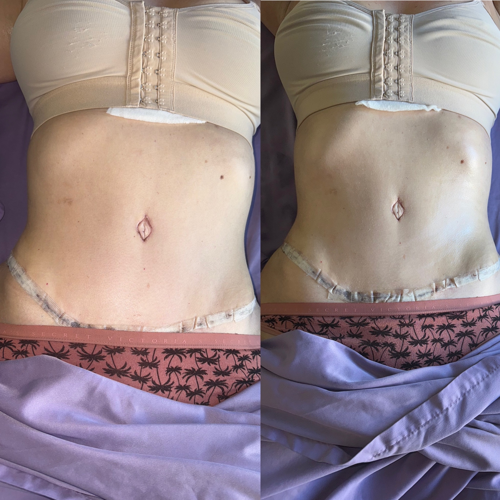 Lymphatic drainage before and after result