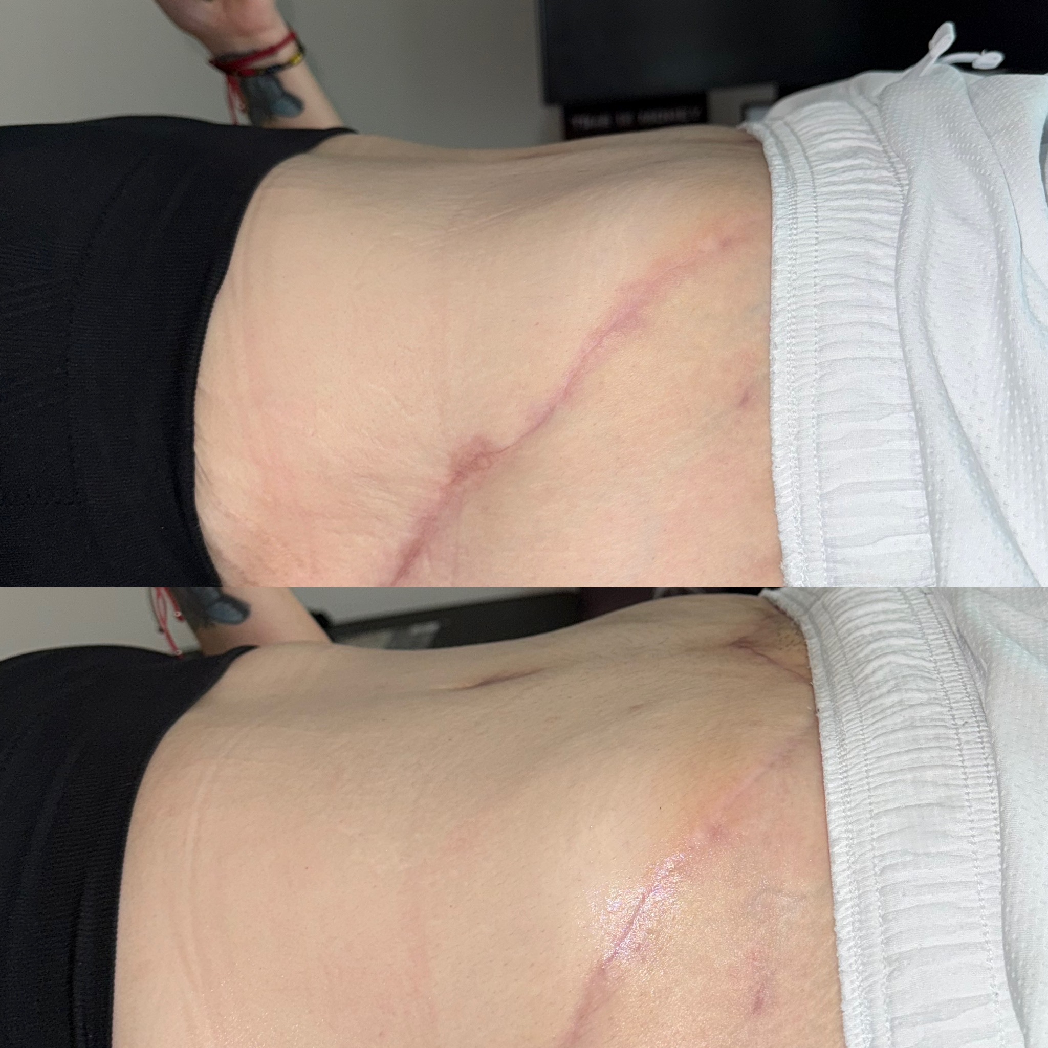 Lymphatic drainage before and after result