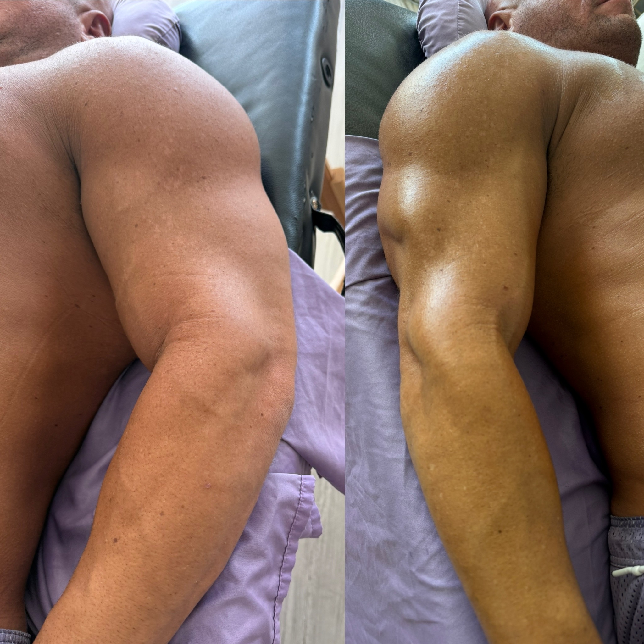Lymphatic drainage before and after result