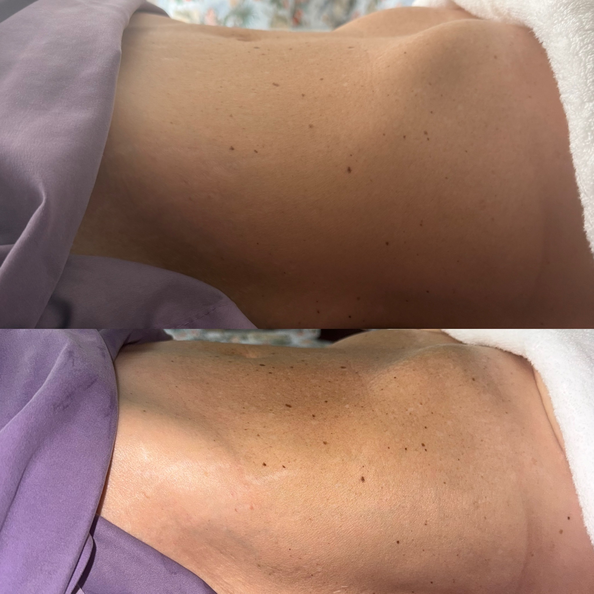 Lymphatic drainage before and after result